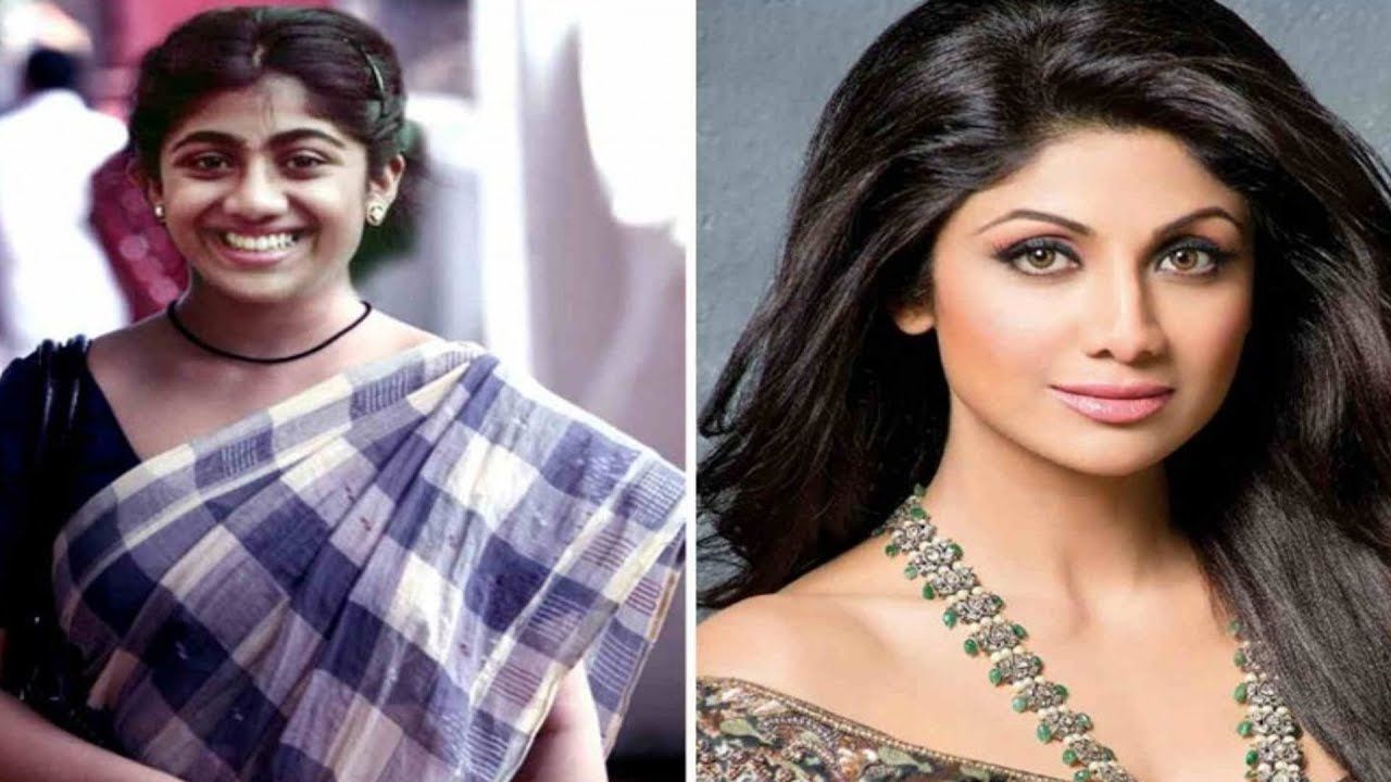 Shilpa Shetty Plastic surgery