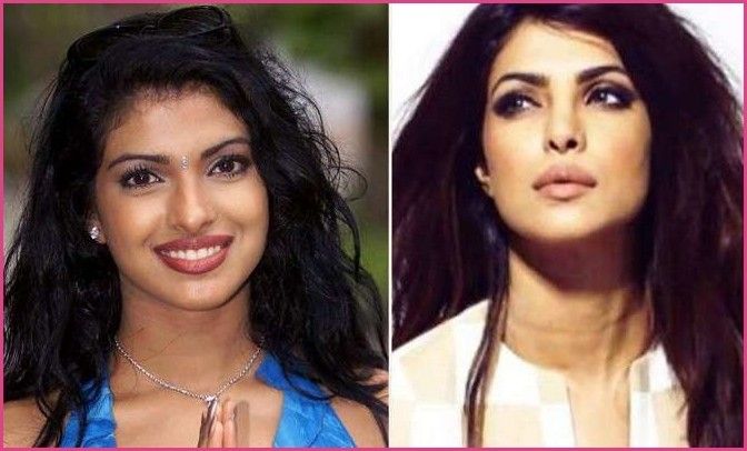 Priyanka Chopra plastic surgery