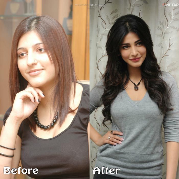 shruti haasan plastic surgery