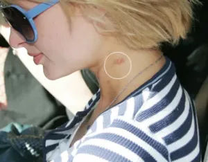 paris hilton love bite on her neck