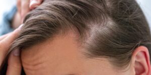 It is not uncommon to lose between 50 to 100 strands of hair daily. A significant hair fall is when you are losing more than 100 strands of hair daily this is called hair loss. Hence the reason why you need to know the hair loss causes. hair loss, hair loss reasons, hair loss reasons in females, hair loss in men, hair loss for men, hair loss vs hair fall, reasons of hair loss in females, hair loss causes vitamin deficiency, excessive hair loss reasons, for hair loss which doctor, what are the reasons of hair loss,