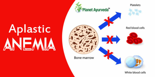 Aplastic Anemia - Types Of Anemia