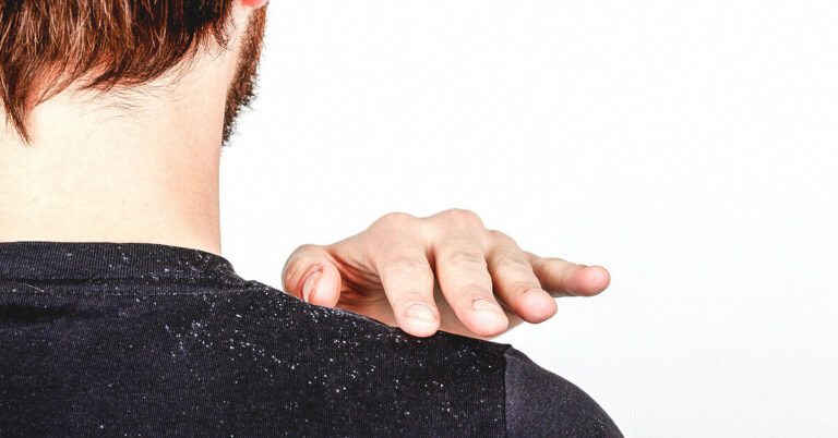 What Causes Dandruff & Dandruff Remedies At Home To Get Rid Of It