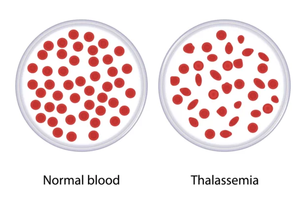 Thalassemia Image Mews - Types Of Anemia