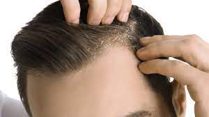 Looking to get rid of your dandruff? In this article, we will share all the details on dandruff causes and dandruff remedies that work. dandruff on scalp , what causes dandruff, dandruff in hair , dandruff remedies at home,