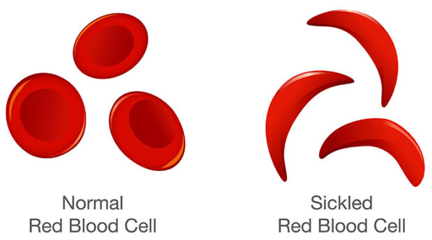 Sickle Red Blood Cell - Types Of Anemia