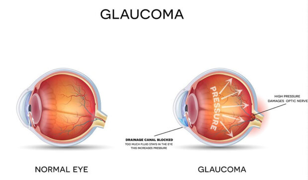 Glaucoma - Mews - image