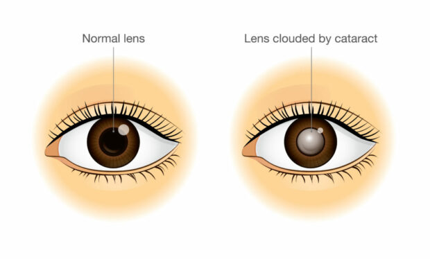 Cataract - Eye - Mews - Image