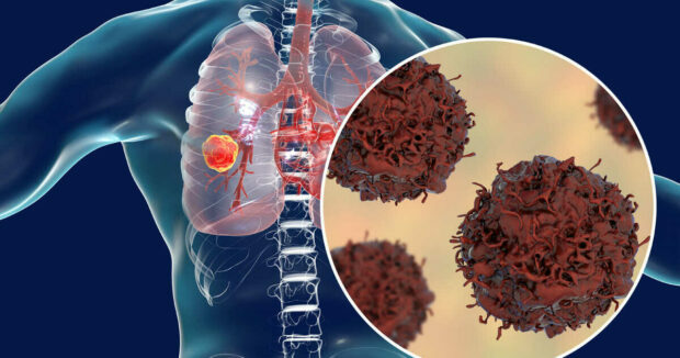 Lung Cancer - Types Of Cancer