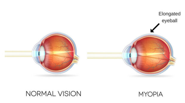 Myopia - Mews - Eye
